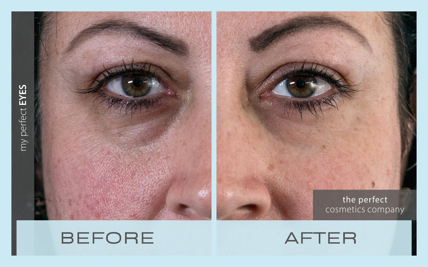 Surgical Treatments for Dark Circles – Are They Worth It?